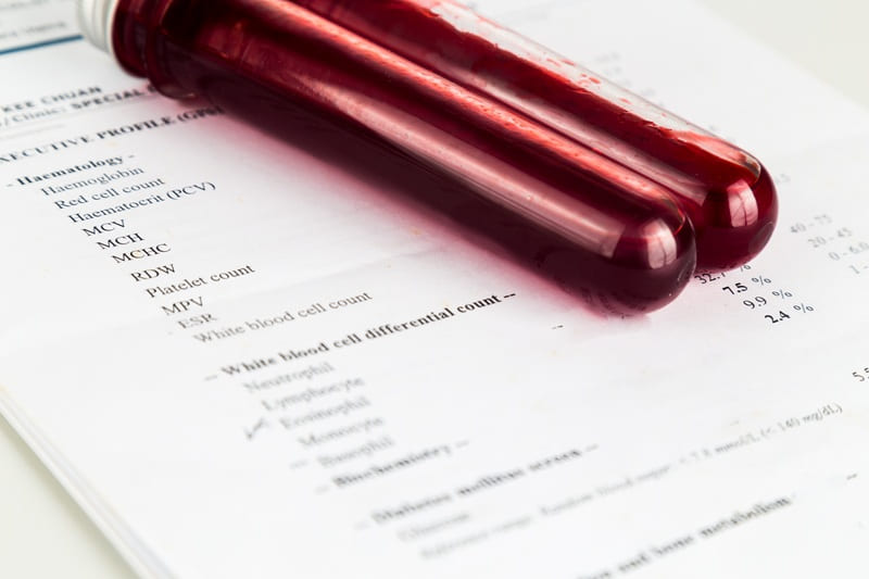 Tratamiento de neoplasias mieloproliferativas en Guatemala